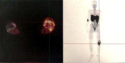 Unusual Presentation and Surgical Treatment of a Phosphaturic Mesenchymal Tumor in a Knee